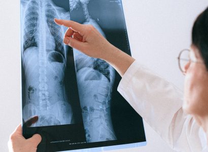 Лечение гистиоцитоза легких в Германии