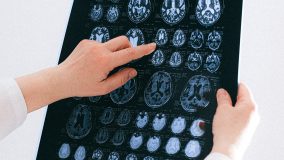 Тест на эпилепсию онлайн — можно ли определить болезнь без обследования?